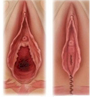 resultat-vaginoplastie-tunisie