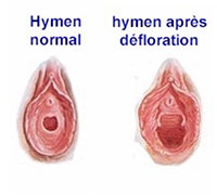 hymen-normal-et-apres-defloration